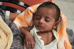 A resting Indian baby with a scar down his chest