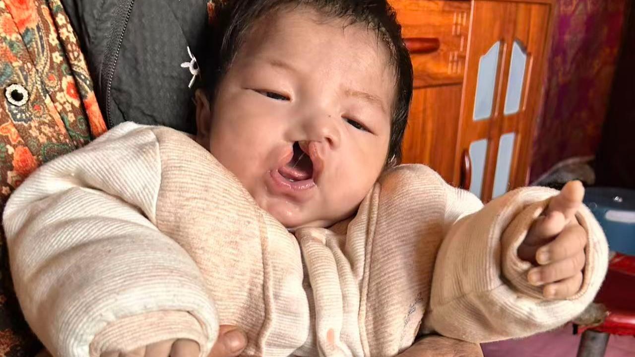 Griffin has a large unilateral cleft lip and palate on the right side.  He is being held by his parent and is wearing thick, cozy, cream colored baby pajamas.