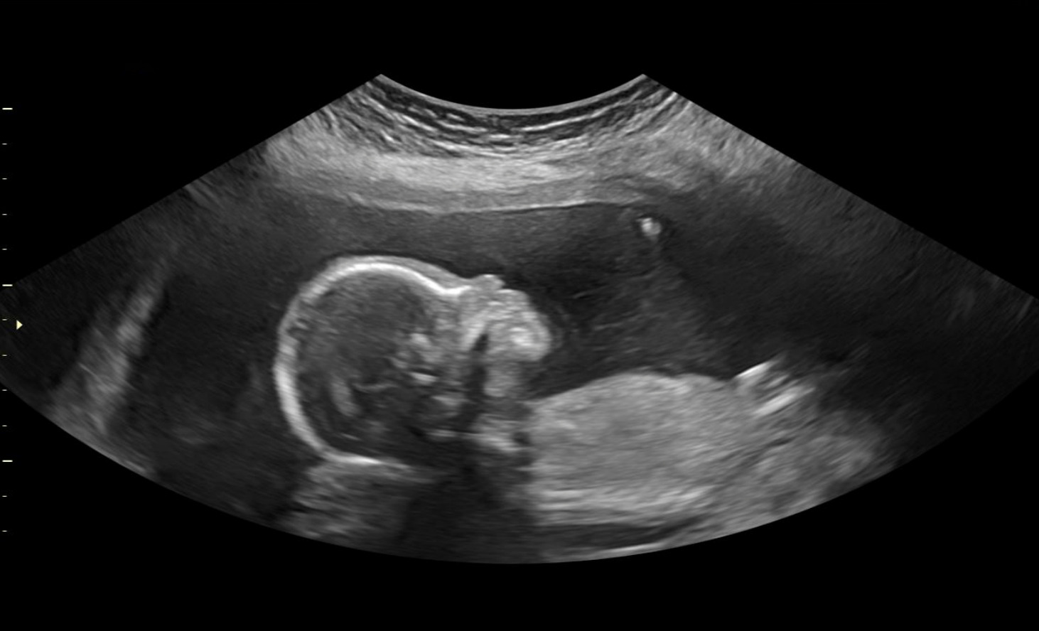 An ultrasound image showing a developing baby